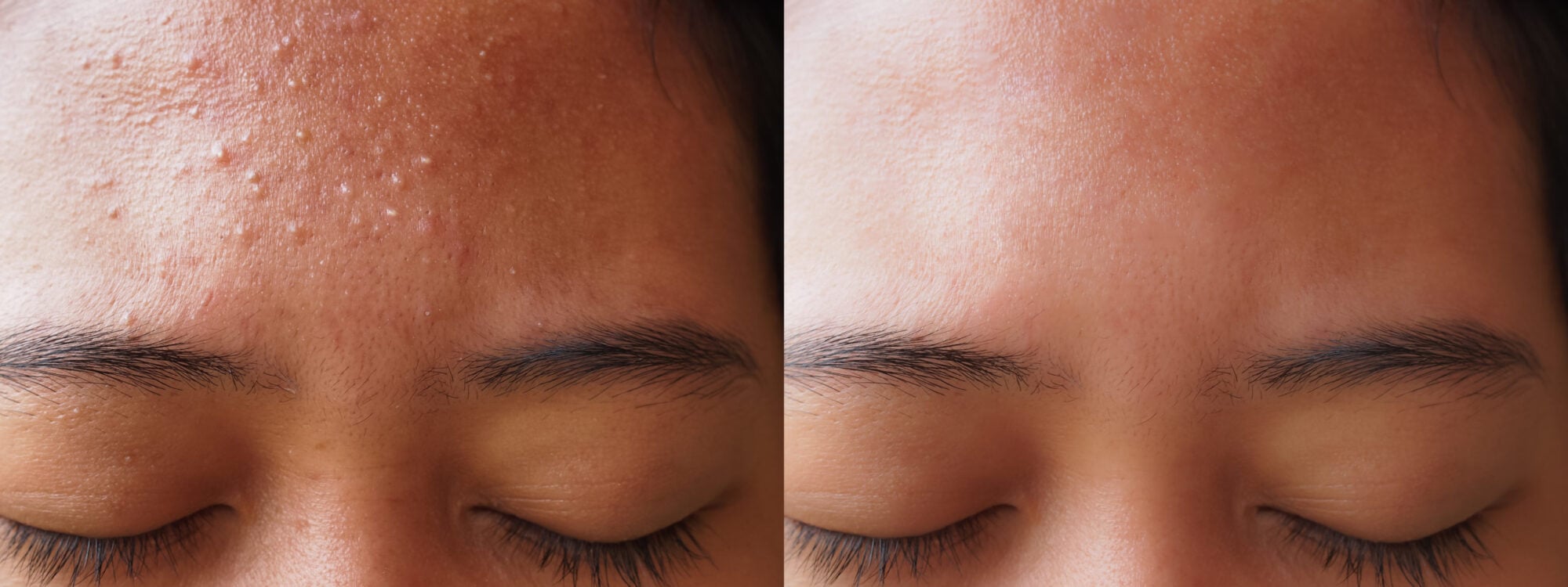 Acne Facials Treatment