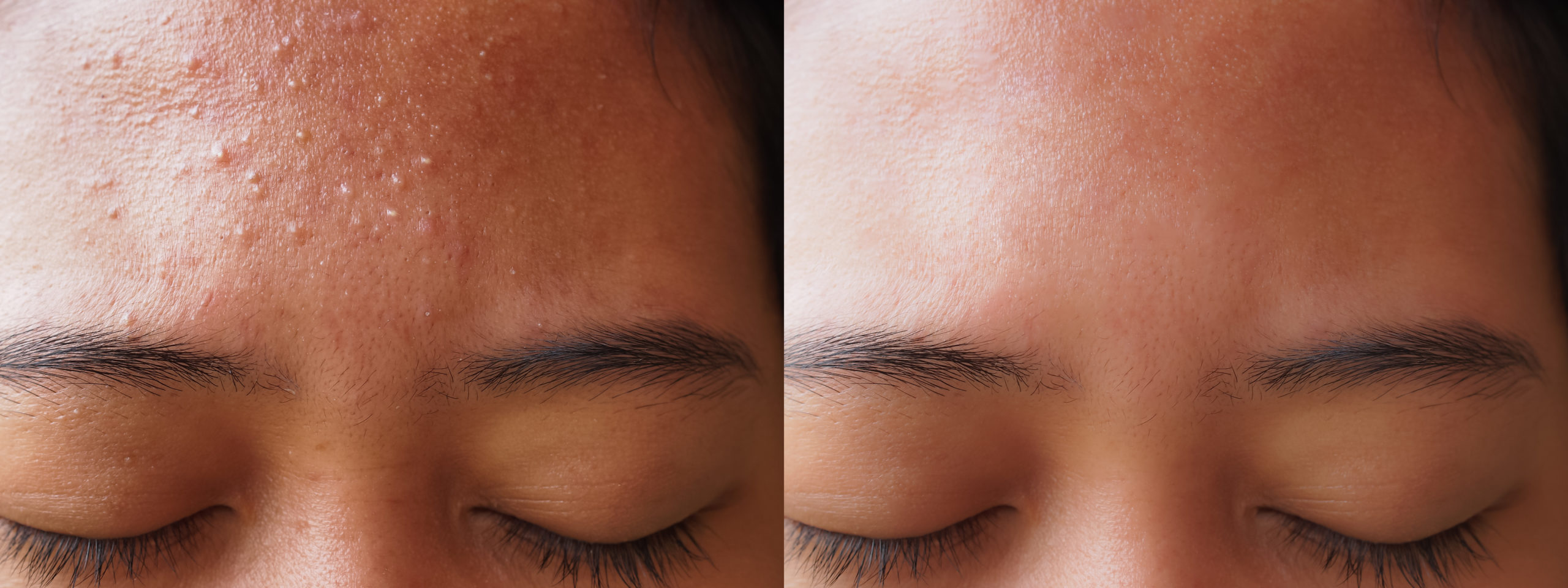 Acne Facials Treatment