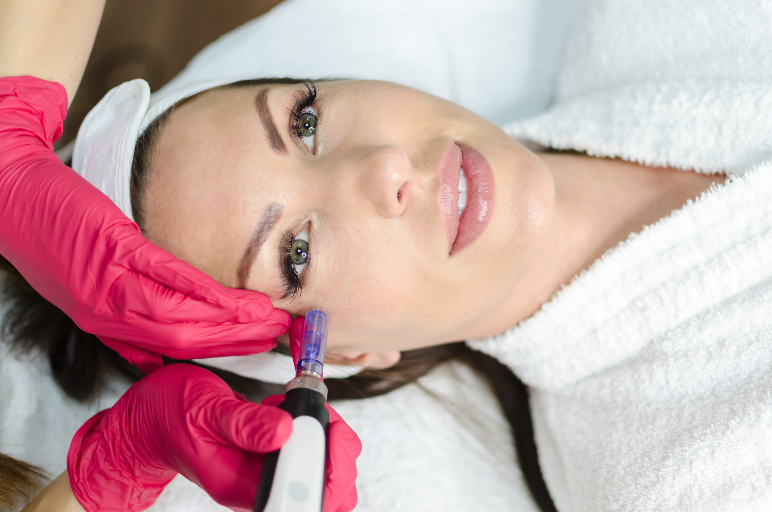 microneedling