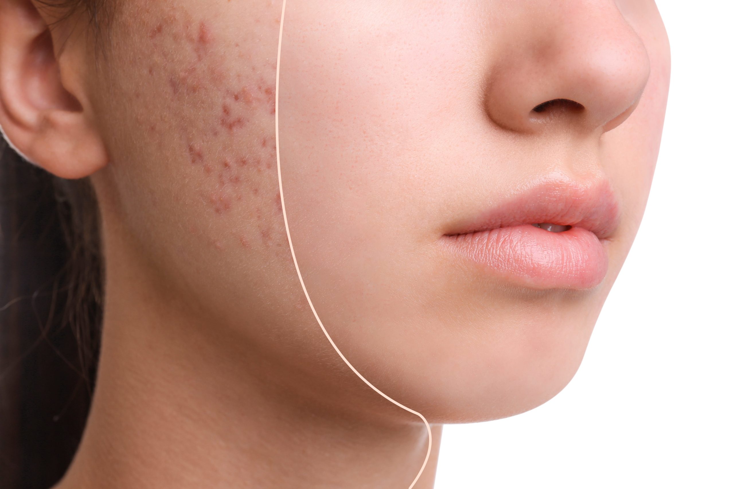 How Can I Permanently Cure Acne