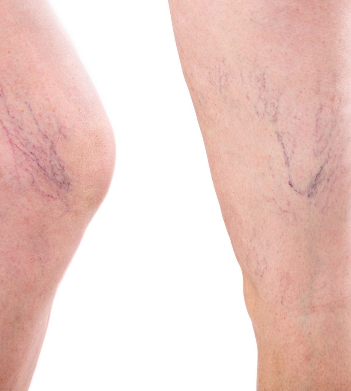 Spider Veins | Sclerotherapy