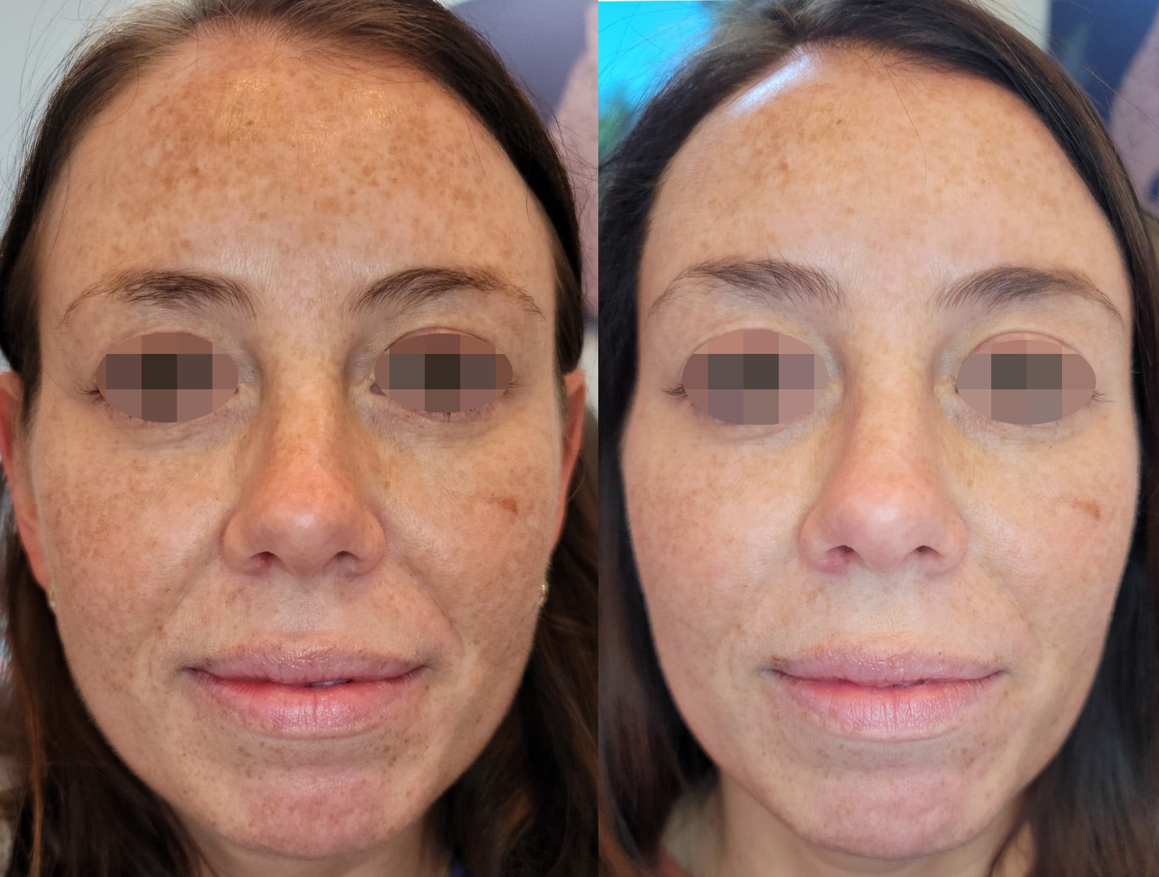 Opus Plasma Skin Resurfacing