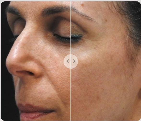 ClearLift