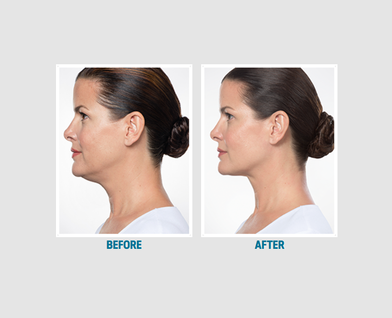 Kybella